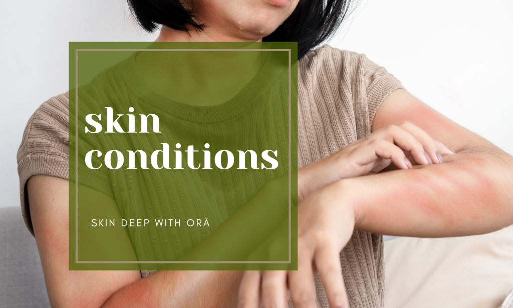 Eczema/Psoriasis/ Rosacea Solutions